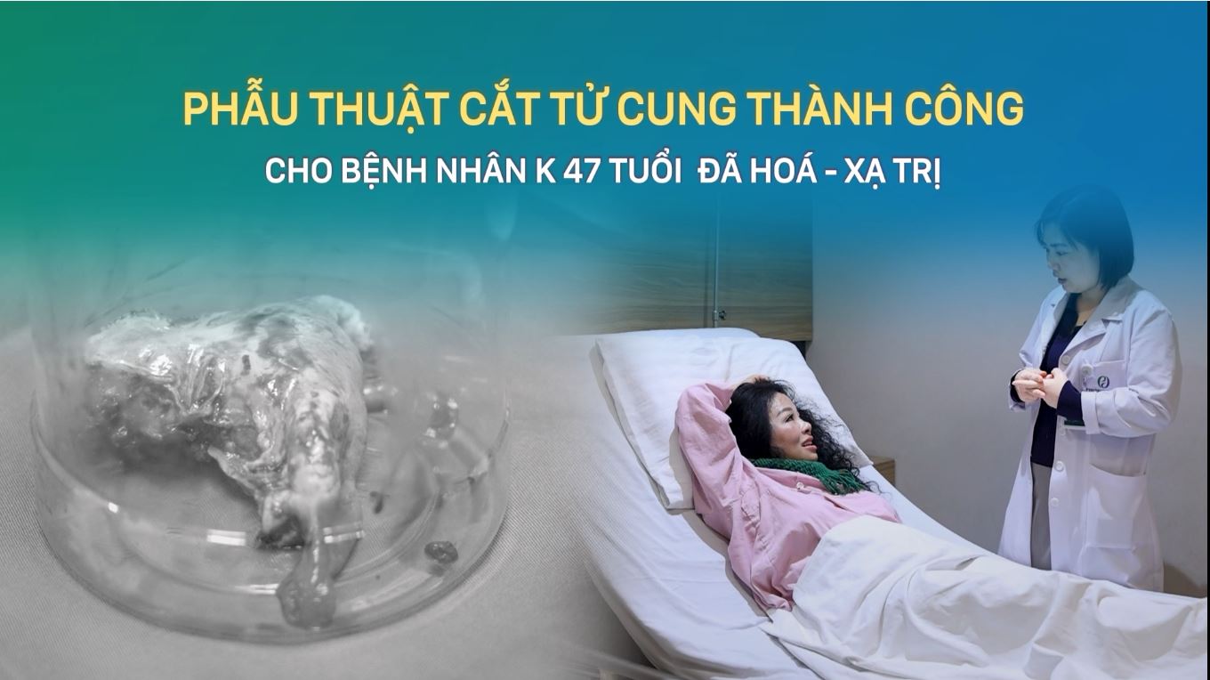 Phẫu thuật cắt tử cung thành công cho bệnh nhân K 47 tuổi đã hóa - xạ trị