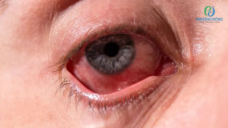 Khi xuất huyết, mắt người bệnh có thể bị căng, nhức do tiếp xúc với ánh sáng mạnh