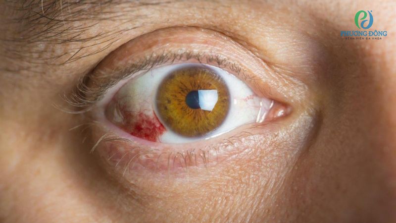 Các cách kiểm soát, phòng ngừa nguy cơ tụ máu mắt