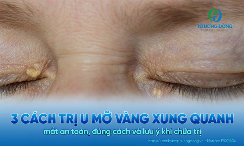 3 Cách trị u mỡ vàng xung quanh mắt an toàn, đúng cách và lưu ý khi chữa trị 