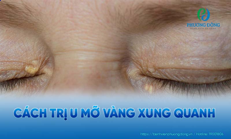 U mỡ vàng quanh mắt là tổn thương lành tính