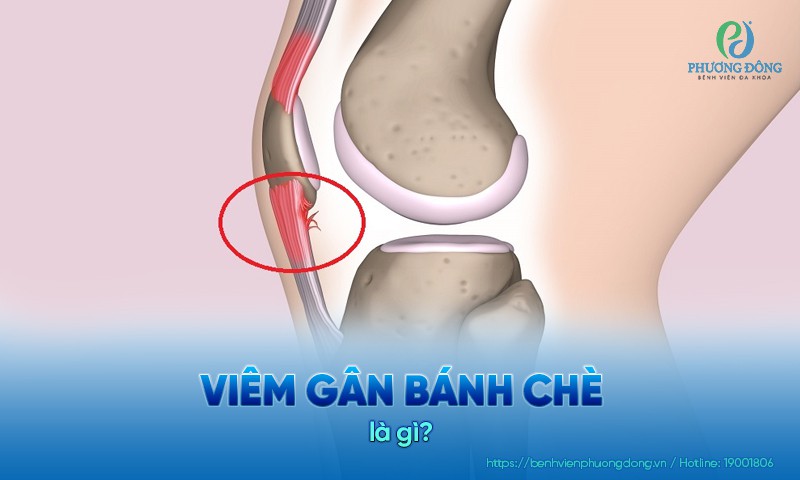 Viêm gân bánh chè: Dấu hiệu, nguyên nhân và  hướng điều trị
