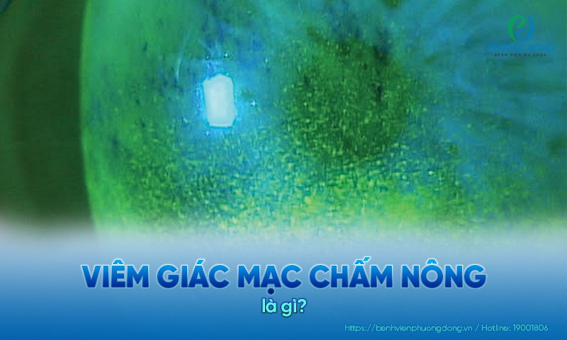 Viêm giác mạc chấm nông: Nguyên nhân, dấu hiệu và điều trị