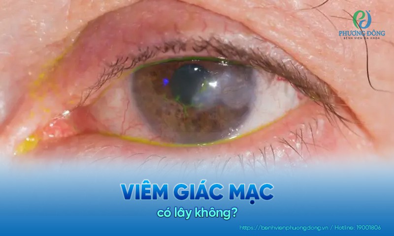 Viêm giác mạc có lây không? Con đường truyền nhiễm và cách phòng tránh