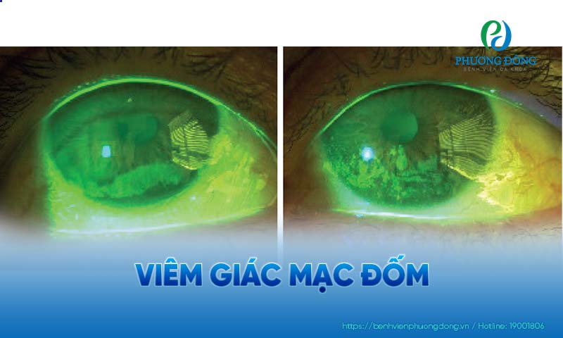 Giác mạc xuất hiện các vết đốm là triệu chứng đặc trưng của bệnh lý về mắt