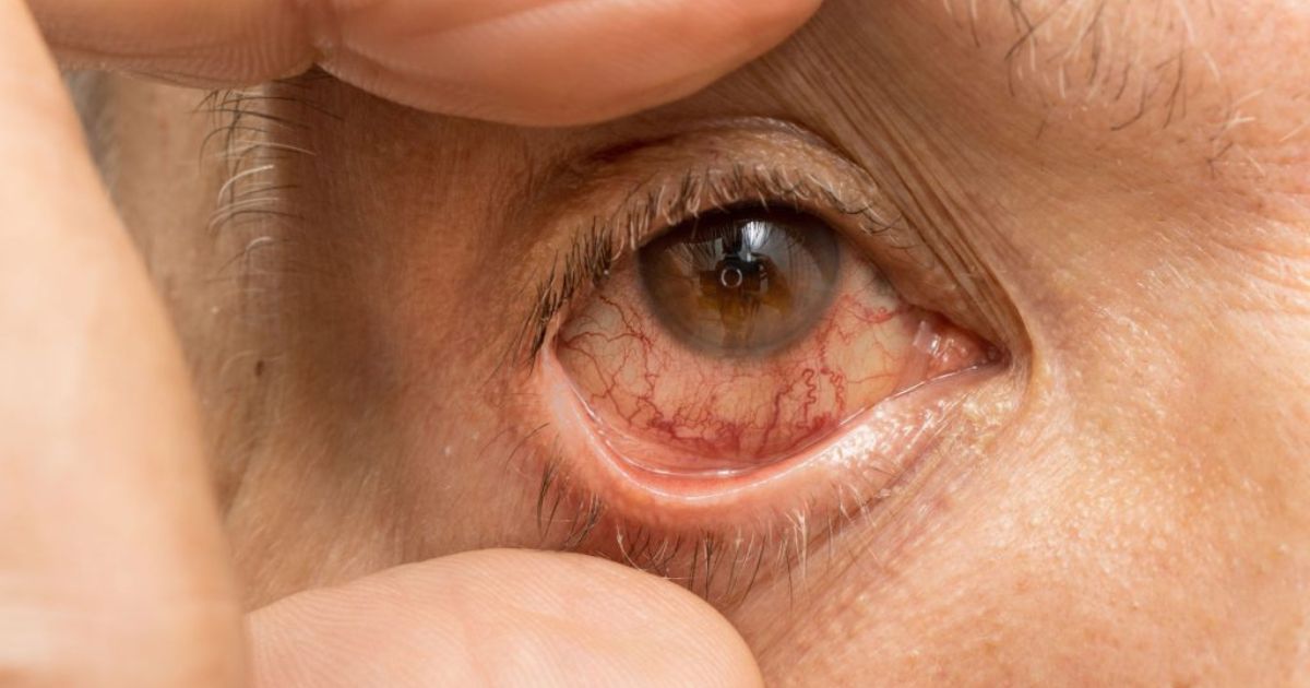 Viêm giác mạc không điều trị kịp thời có thể dẫn đến nhiễm trùng mắt