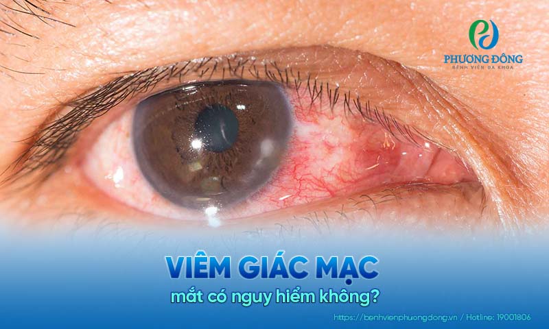 Hỏi đáp với bác sĩ chuyên khoa Mắt: Viêm giác mạc mắt có nguy hiểm không?