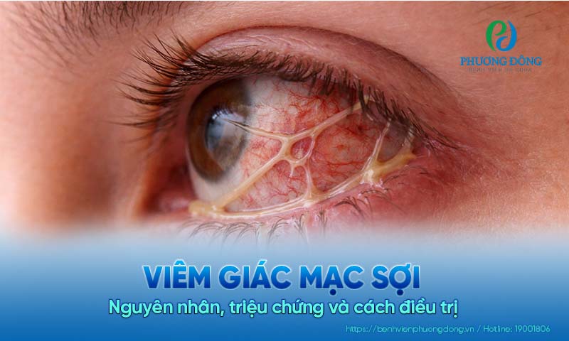 Viêm giác mạc sợi: Nguyên nhân, triệu chứng và cách điều trị 