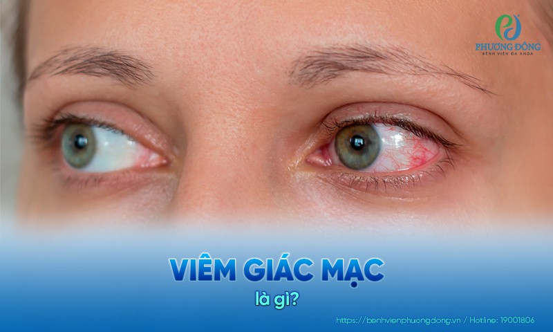 Viêm giác mạc là gì? Dấu hiệu, nguyên nhân và cách điều trị