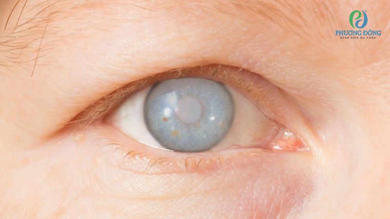Viêm mống mắt thể mi không được kiểm soát tốt có thể dẫn đến đục thuỷ tinh thể, tăng nhãn áp