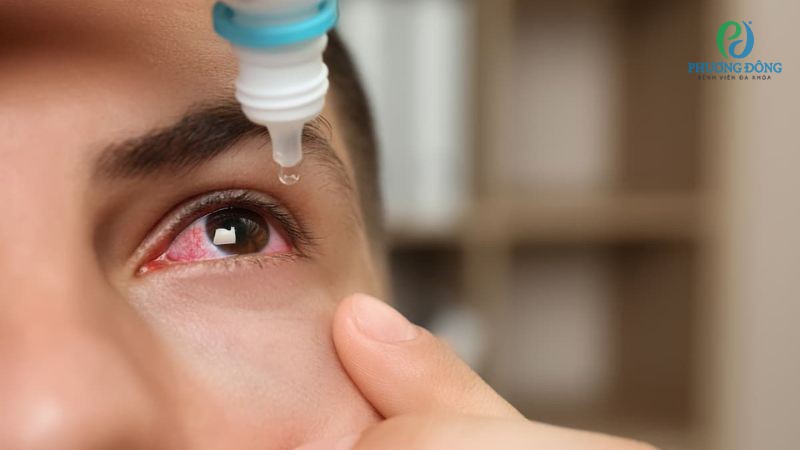 Điều trị tình trạng viêm bằng thuốc corticoid tại chỗ, giãn đồng tử hoặc corticoid toàn thân