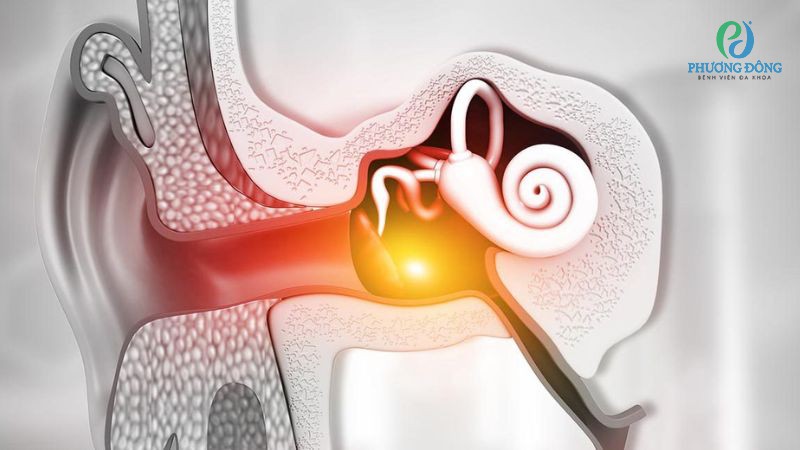 Barotrauma là tình trạng tổn thương thay do thay đổi áp suất đột ngột