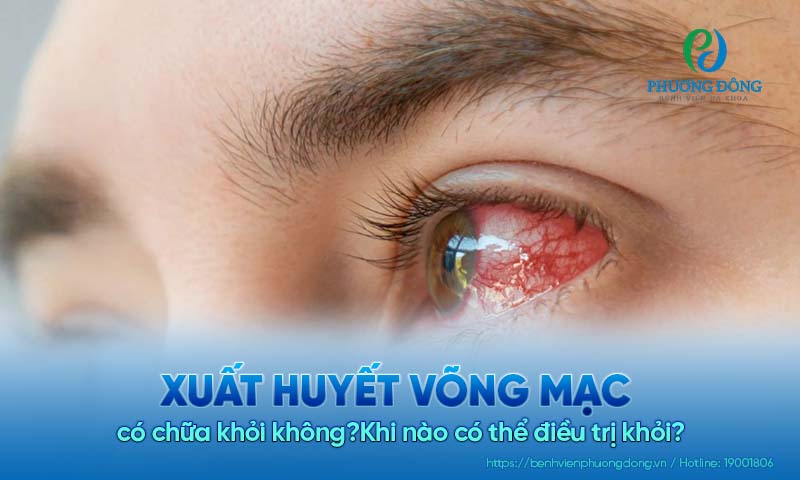 Xuất huyết võng mạc có chữa khỏi không?Khi nào có thể điều trị khỏi?