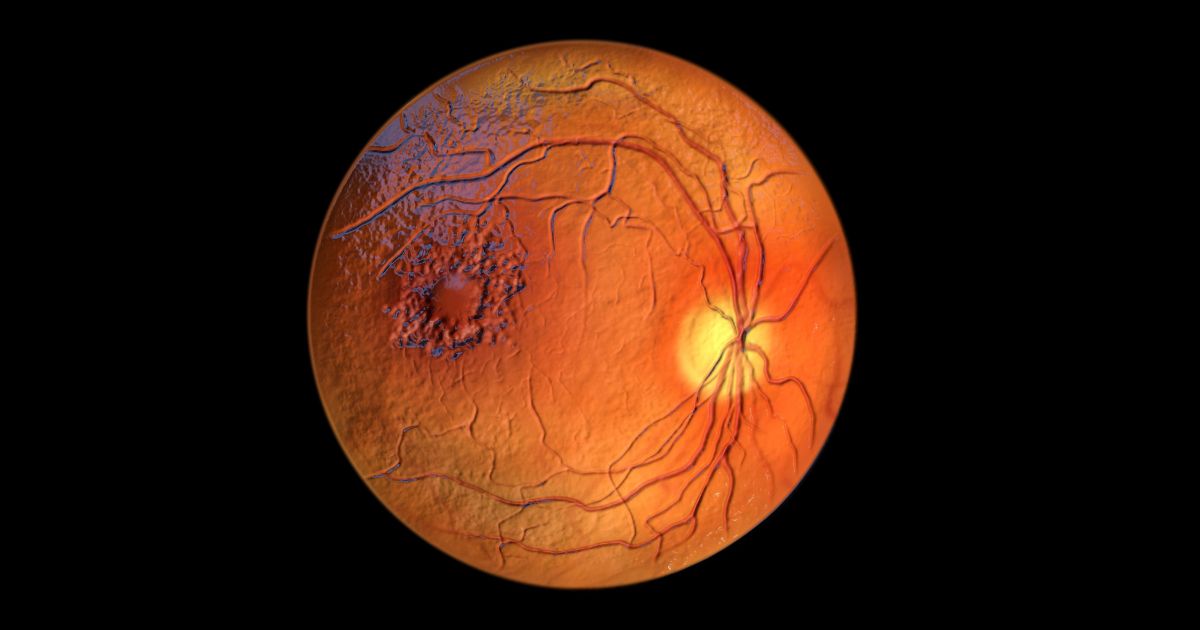  Nếu hoàng điểm bị tổn thương việc điều trị sẽ vô cùng khó khăn