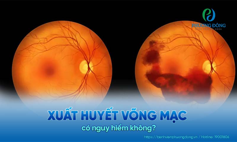 Bệnh nhân chuyên khoa trả lời: Xuất huyết võng mạc có nguy hiểm không?