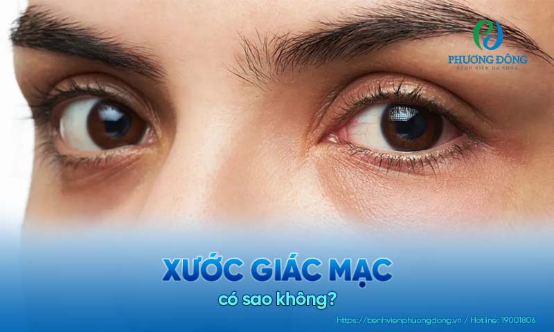 Hỏi đáp với bác sĩ Nhãn khoa: Xước giác mạc có sao không?