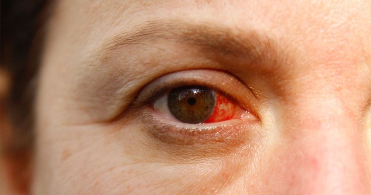 Chấn thương mắt gây xước giác mạc là trường hợp cần can thiệp y tế ngay