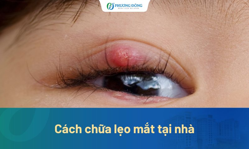 Mách bạn 9 cách chữa lẹo mắt tại nhà đơn giản, hiệu quả