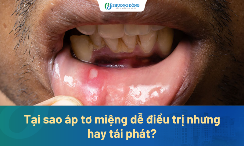 Tại sao áp tơ miệng dễ điều trị nhưng hay tái phát?