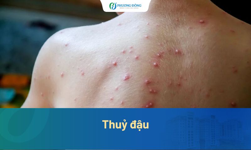 Bệnh thủy đậu là gì? Làm sao để không bị lây bệnh thủy đậu?