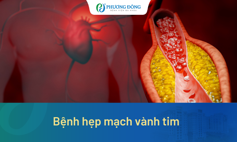 Bệnh hẹp mạch vành tim nguy hiểm như thế nào? Khi nào phải can thiệp?