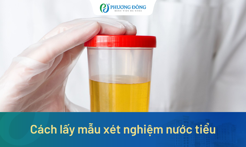 Hướng dẫn cách lấy mẫu xét nghiệm nước tiểu theo từng phương pháp