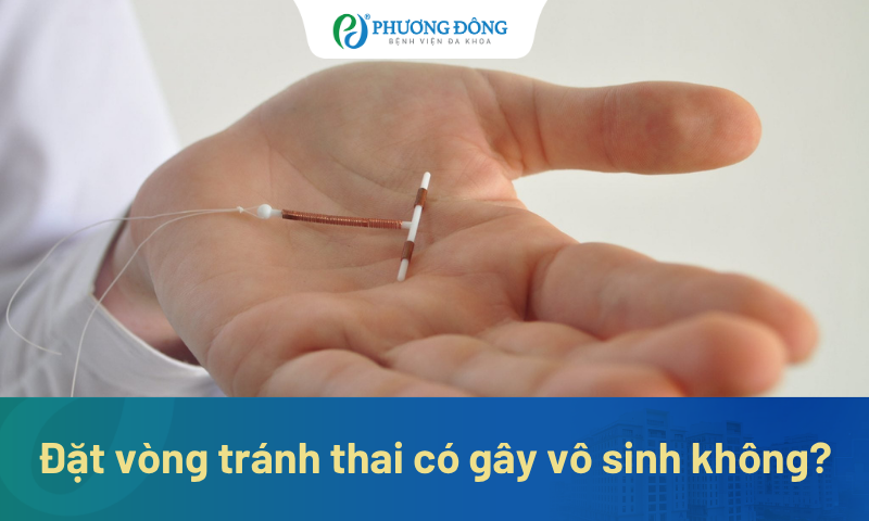 Đặt vòng tránh thai có gây vô sinh không? Tại sao?
