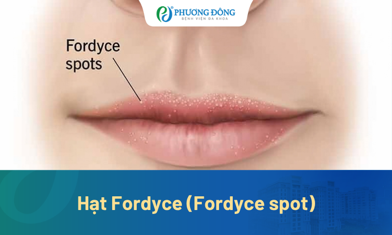 Hạt Fordyce (Fordyce spot): Dấu hiệu, nguyên nhân và cách xử lý