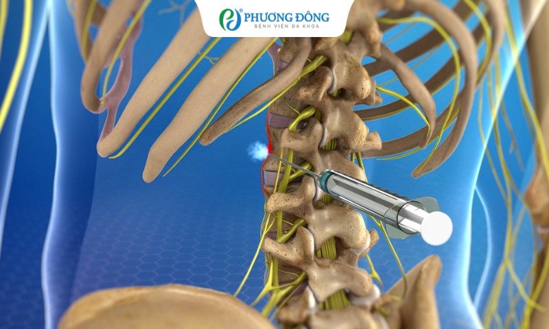 Bị viêm thoát vị đĩa đệm có cần tiêm phong bế không?