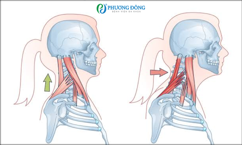 Các bài tập phục hồi chức năng có chữa được hội chứng cổ rùa không?