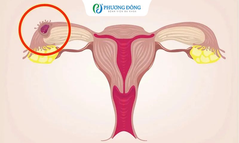 Chuyển phôi mà vẫn bị chửa ngoài là do đâu?