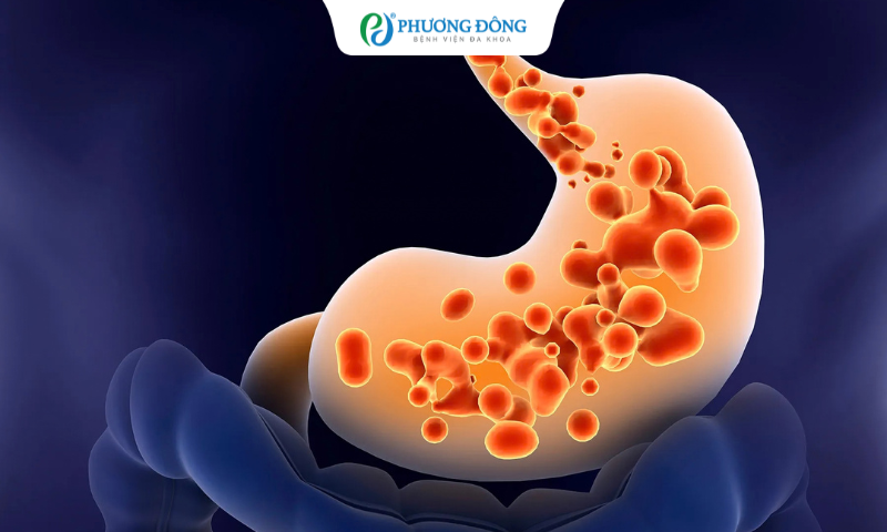 Có cách nào để giảm bớt trào ngược không?