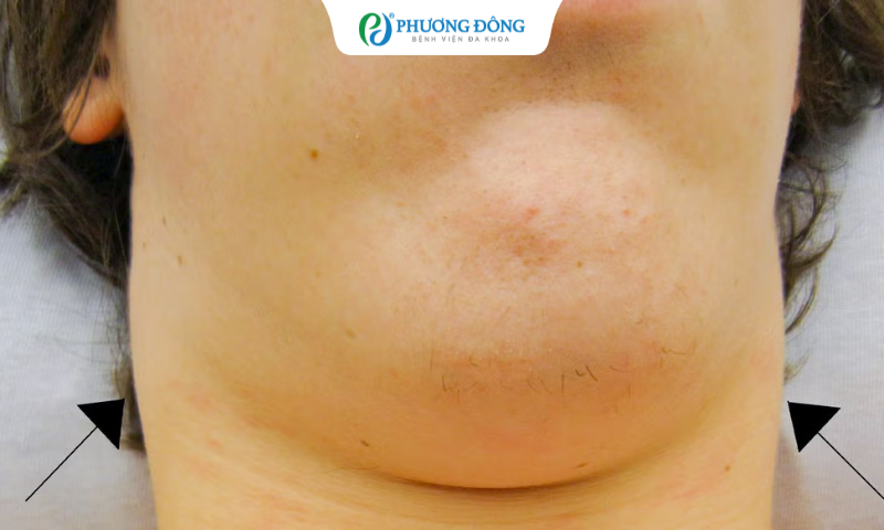 Sưng hạch cổ là dấu hiệu nổi bật của bệnh ung thư tuyến giáp