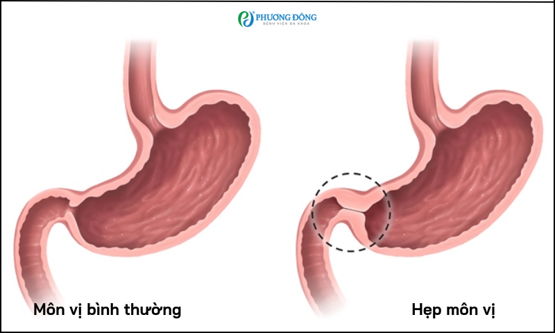 Hẹp môn vị có nguy hiểm không?
