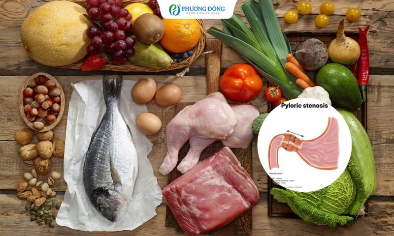 Hẹp môn vị nên ăn gì?
