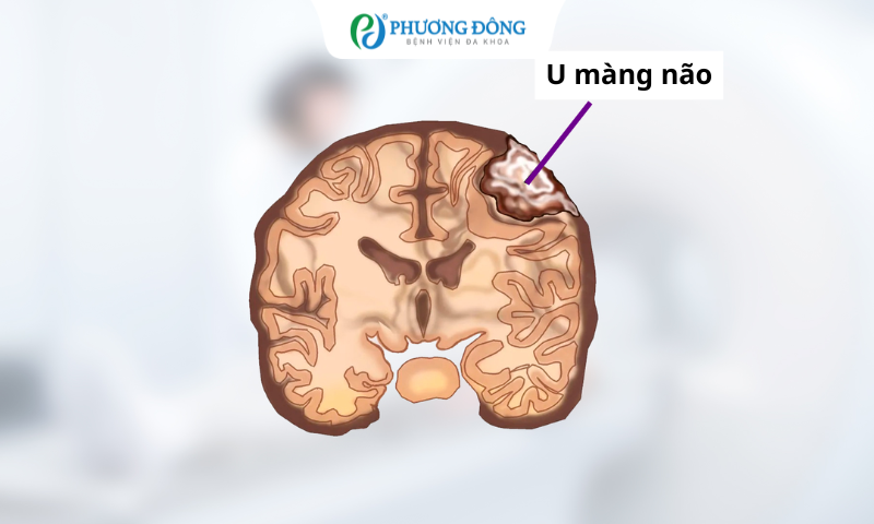 Làm thế nào để nhận biết bị u màng não?