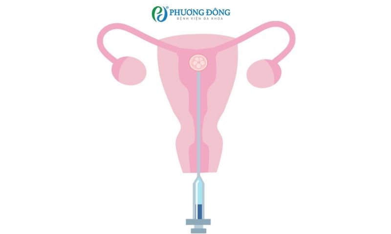 Polyp tử cung có chuyển phôi được không?