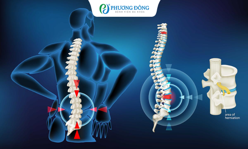 Thoát vị đĩa đệm trở nặng hơn có bị sao không?