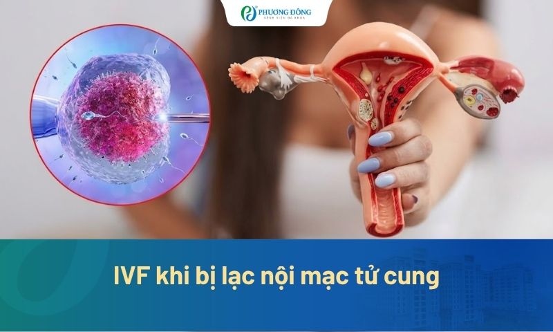 IVF khi bị lạc nội mạc tử cung cơ hội mang thai thế nào?