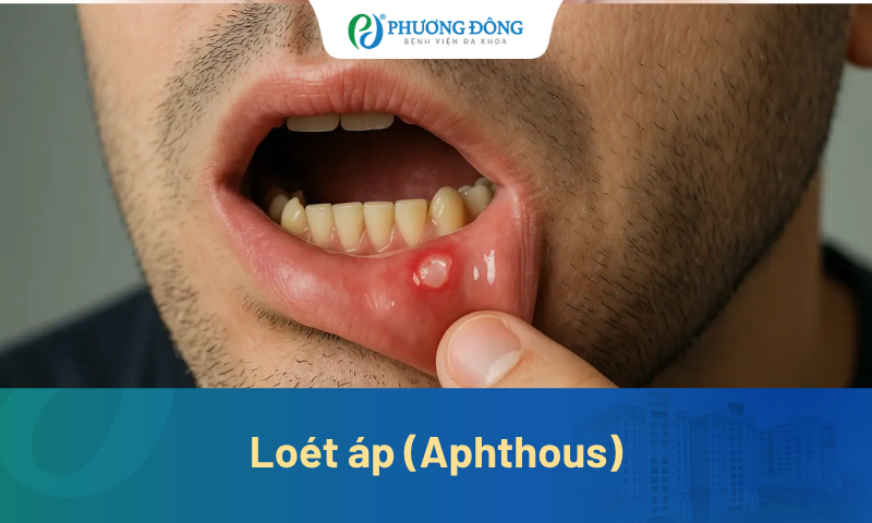 Loét áp (Aphthous) là gì? Nguyên nhân và cách điều trị