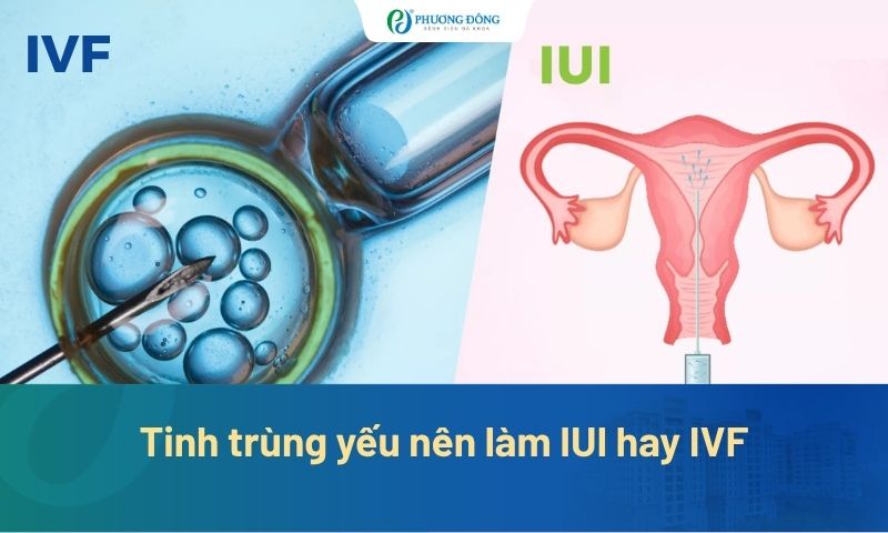 Tinh trùng yếu nên làm IUI hay IVF? Cách tăng cơ hội có thai?