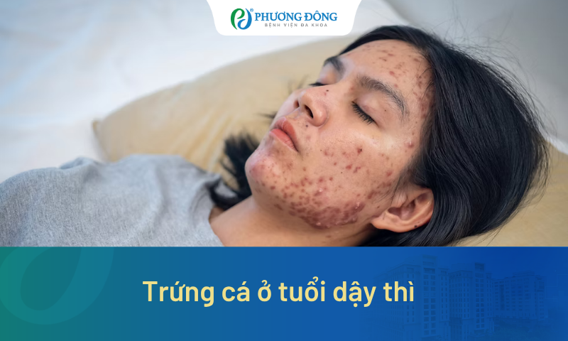 Trứng cá tuổi dậy thì: Đừng để vài nốt mụn trở thành những vết sẹo cả đời