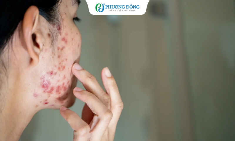 Thói quen hay sờ tay lên mặt cũng có thể là nguyên nhân gây ra mụn trứng cá ở tuổi dậy thì