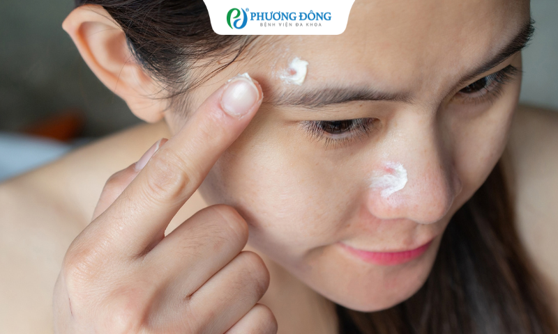 Một trong số các cách điều trị trứng cá phổ biến là dùng thuốc bôi