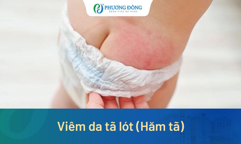 Viêm da tã lót (Hăm tã): Nhận biết sớm, chăm sóc đúng cách để bảo vệ làn da của bé