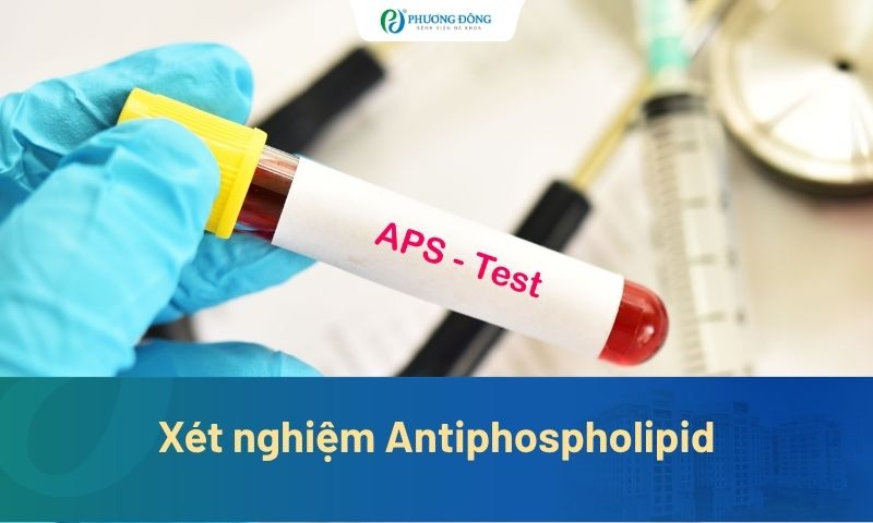 Xét nghiệm Antiphospholipid khi nào cần làm? Giá bao nhiêu?