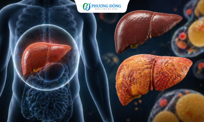 Chỉ số creatinin cảnh báo các bệnh lý về gan, thận