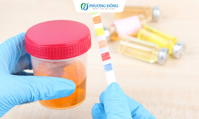 Người bệnh cần thu thập nước tiểu trong vòng 24h để định lượng nồng độ creatinin