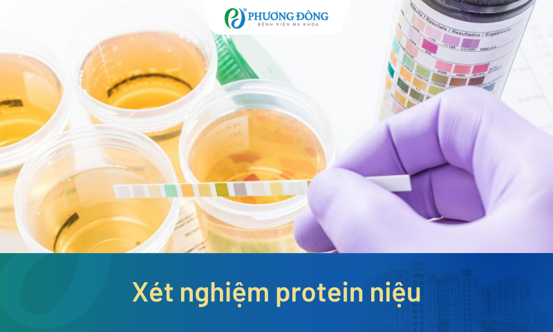 Xét nghiệm protein niệu giúp phát hiện ra bệnh gì? Diễn ra như thế nào?