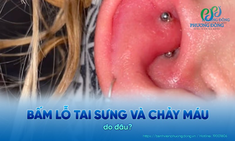 Bấm lỗ tai bị sưng và chảy máu: Nguyên nhân và cách điều trị an toàn
